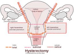 Diagram of a hysterectomy 