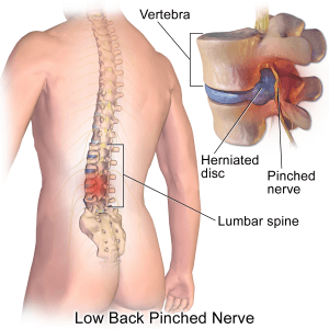 Our Detroit personal injury lawyers discuss herniated disc injuries.
