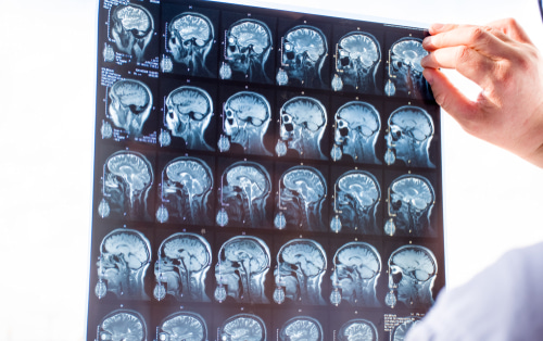 Doctor holding an MRI film of side-view brain scans up to the light